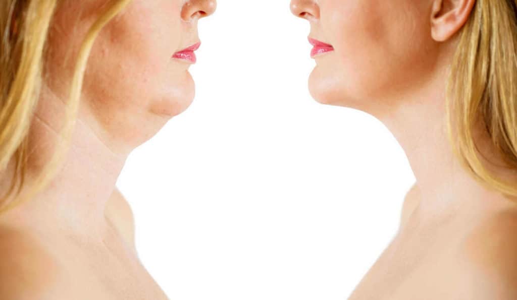 Double Chin treatment Market Harborough before and after results