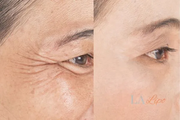 Before and after results of woman - HI-fu wrinkles reduction treatment Market Harborough