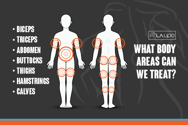 Graphic to show areas you can have LA-EMS Body Sculpting Market Harborough treatment.