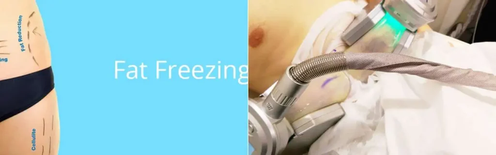 Fat freezing Market Harborough on multiple areas of the body