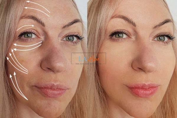 Morpheus 8 results Market Harborough face lift.
