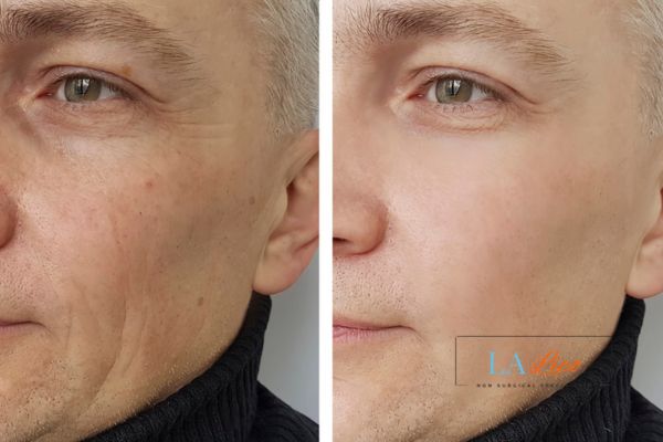 See the amazing results of Morpheus8 Treatment Market Harborough!