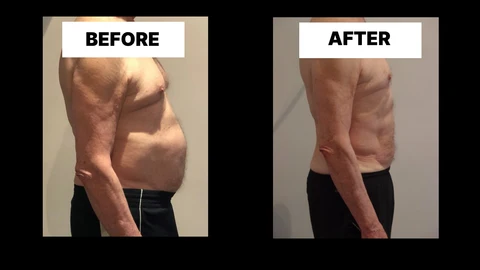 What Symptoms Can Diastasis Recti Cause in Men? Weak Core, Back Pain and Poor Posture Market Harborough